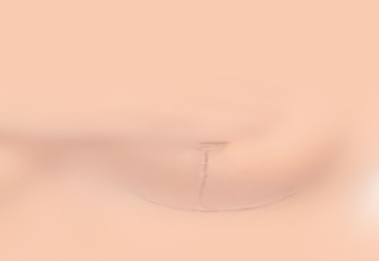 KELO-COTE® is effective on cosmetic surgery scars