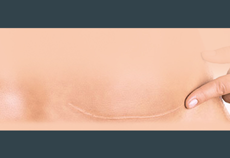 KELO-COTE® is effective on c-section scars
